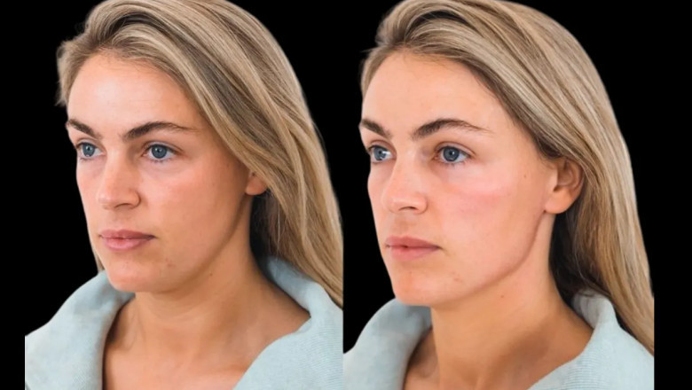 How to Take Care of Your Skin After Cheek Fillers Treatment in Dubai