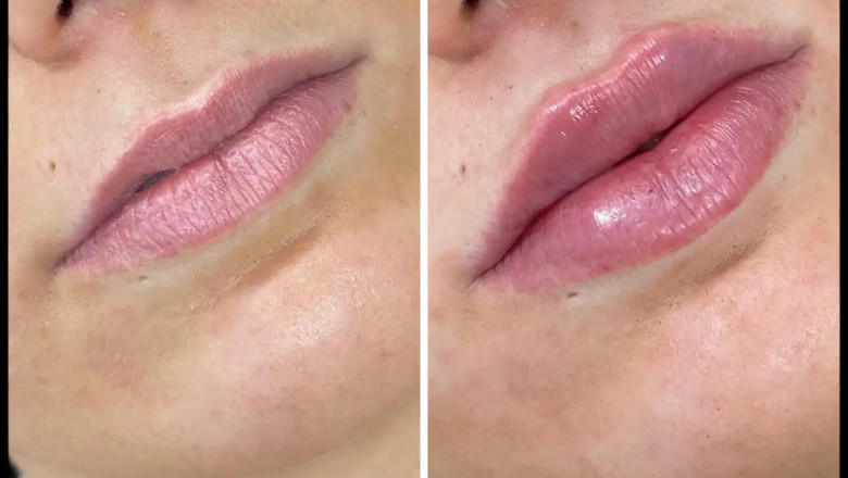 Russian Lip Fillers Treatment in Dubai: Subtle Enhancements for Fuller Lips