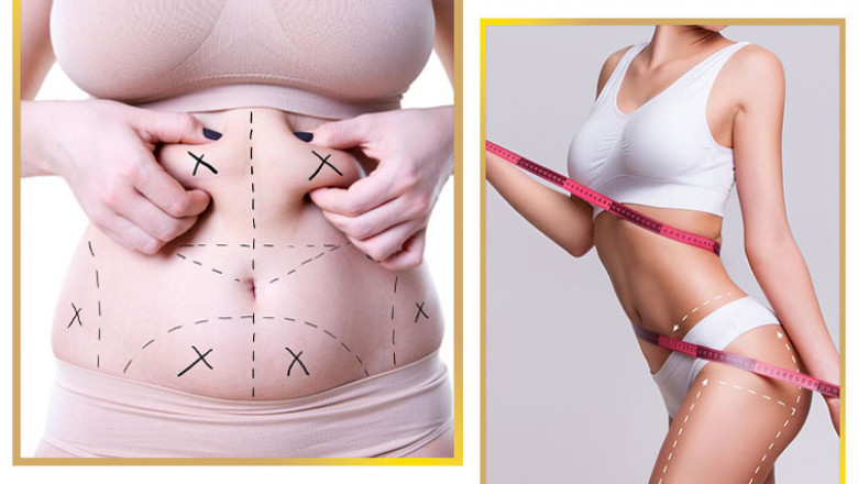 Why Liposuction in Islamabad Is Gaining Popularity in Pakistan