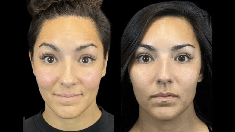 How the Best Aesthetic Clinics in dubai Ensure Safe Botox Procedures